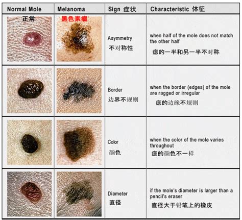 有問題的痣|哪種痣是致死率超高的「索命痣」？5 大關鍵辨別癌病。